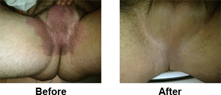 jock itch before and after, jock itch cure, jock itch on penis, jock itch cure fast, jock itch