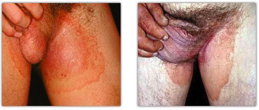 jock itch scrotum
